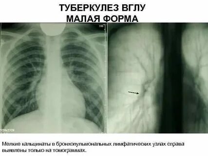 Туберкулез лимфоузлы легких