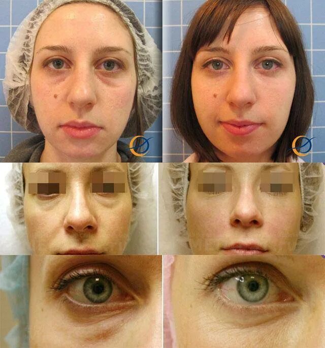 заполнить под глазами. коррекция носослезной борозды. носослезная борозда. коррекция носослезной борозды. скульптурирование слезной борозды.