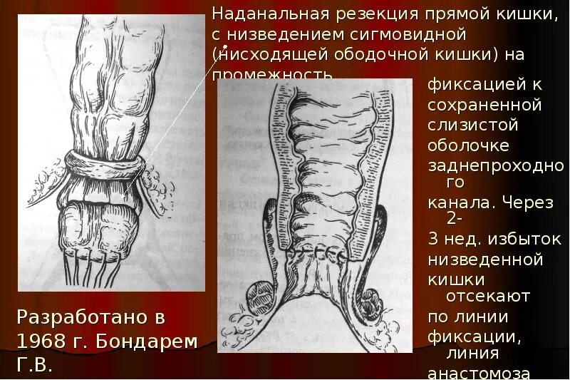 Как понять прямую кишку