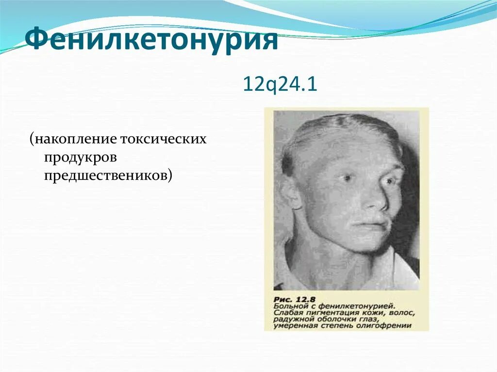 Что такое фенилкетонурия. Фенилкетонурия патанатомия. Фенилкетонурия симптомы. Симптомы фенилкетонурии.