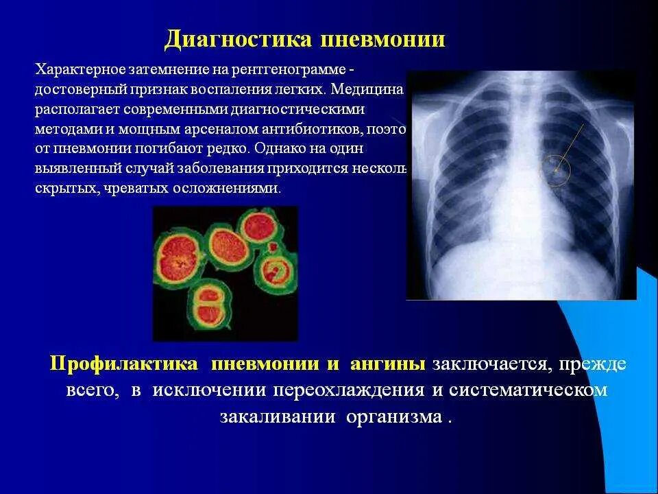 Вирусная пневмония диагноз. Диагностические критерии вирусных пневмоний. Профилактика осложнений пневмонии.