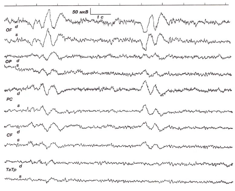 Ээг мозга в спб. Электроэнцефалограмма при опухоли головного мозга. ЭЭГ головного мозга при опухолях головного. Электроэнцефалограмма при новообразованиях. ЭЭГ при коме головного мозга.
