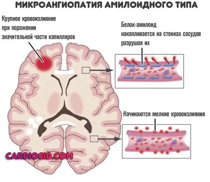 Сосудистый очаг в головном мозге что это. Микроангиопатия лобной доли. Микроангиопатия сосудов головного мозга симптомы. Церебральная амилоидная микроангиопатия мрт. Очаги микроангиопатии головного мозга что это такое.