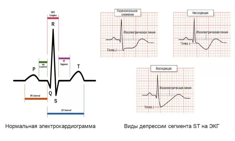 Депрессия сегмента st. ЭКГ депрессия сегмента St 1.0 мм. Депрессия сегмента т на ЭКГ. Сегмент St на ЭКГ В норме и патологии. Депрессия и элевация сегмента St.