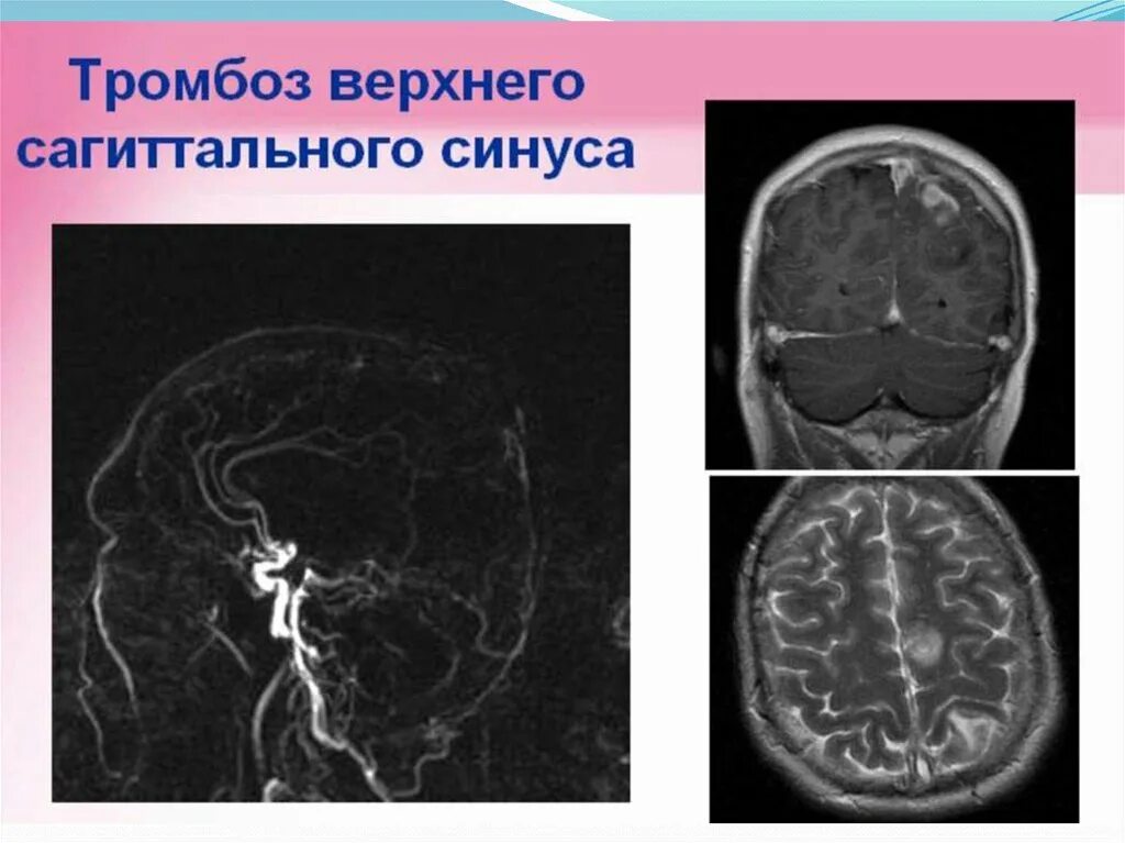 Тромбозы сосудов головного. Синус тромбоз сагиттального синуса кт. Тромбоз кавернозного синуса на кт. Тромбоз пещеристого синуса кт. Синус тромбоз поперечного синуса.