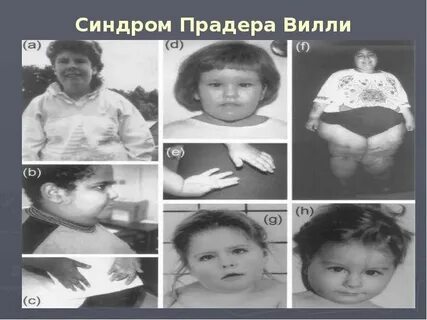 Синдром прада