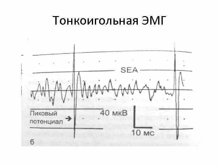 Эмг сайт. Эмг сигнал. параметры сигнала эмг. электромиография. электромиография график.