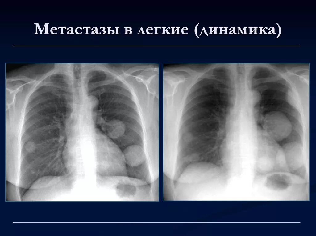 Одиночный метастаз в легком рентген. Метастащв лёгких на рентгене. Метастатическое поражение легких рентген. Рентген грудной клетки метастазы. Признаки метастаз в легких