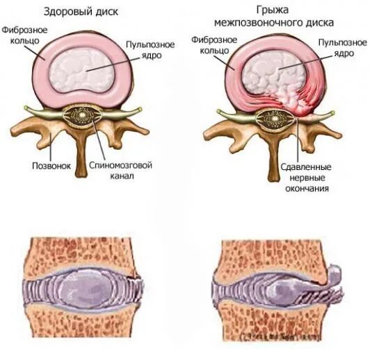 Содержимое межпозвоночного диска. Грыжа межпозвоночного диска разрыв фиброзного кольца. Разрыв фиброзного кольца межпозвоночного диска поясничного отдела. Надрыв фиброзного кольца межпозвоночного диска. Строение фиброзного кольца.