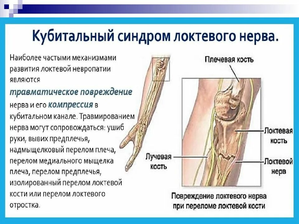 Кубитальный туннельный синдром. Компрессионная нейропатия локтевого нерва. Синдром сдавления локтевого нерва. Компрессионная ишемическая нейропатия лучевого нерва.