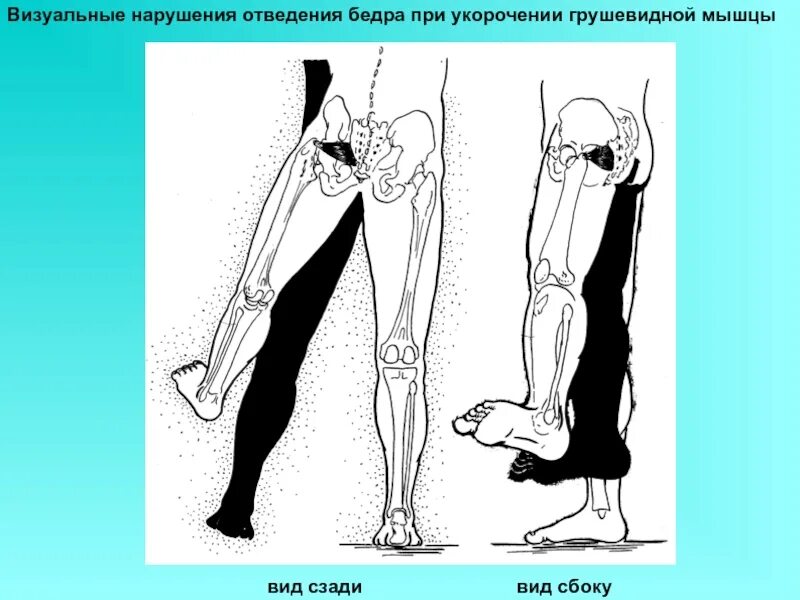 Мышца седалищного нерва. Грушевидная мышца и седалищный нерв. Седалищный нерв грушевидная анатомия. Седалищный нерв спазм мышц. Грушевидная мышца защемление седалищного нерва анатомия.