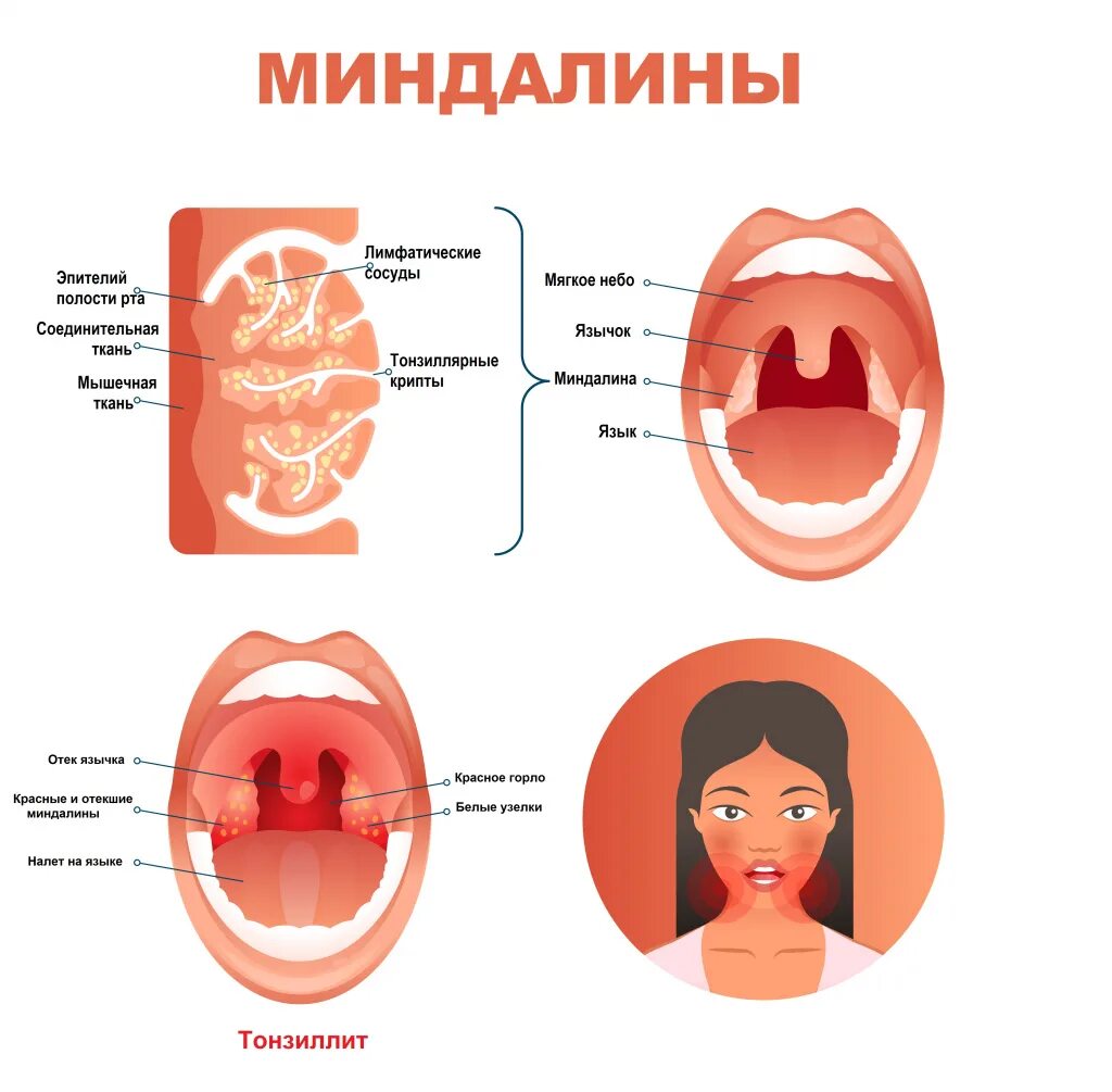 Чем полоскать гнойное горло в домашних. Ангина тонзиллит симптомы. Хронический тонзиллит причины. Воспаление острого хронического тонзиллита.