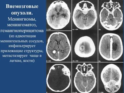 Причины головной опухоли