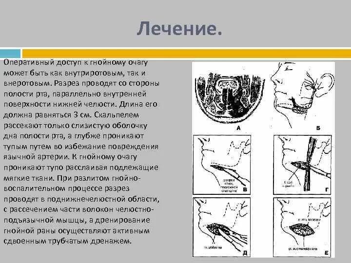 Вскрытие абсцесса алгоритм. Флегмона дна ротовой полости. вскрытие флегмон полости рта. разрез при флегмоне дна полости рта. абсцесс челюстно-язычного желобка.