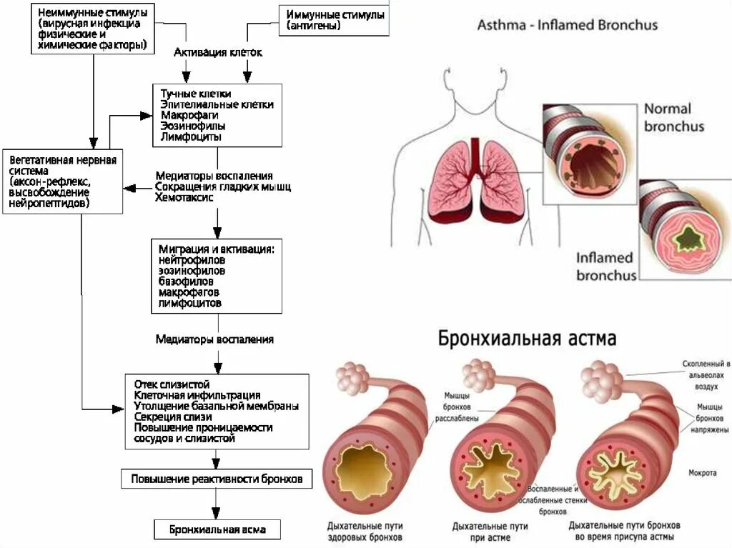 Бронхиальный орви. Механизм бронхиальной астмы схема. Изменения в бронхах при бронхиальной астме. Иммунопатогенез бронхиальной астмы. Бронхиальная астма обструкция.