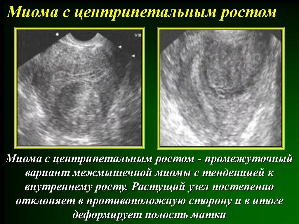 Миома матки с деформацией. Центрипетальный рост узла миомы. Миома с центрипетальным ростом узла что это. Центрипетальная миома матки. Полость матки деформирована