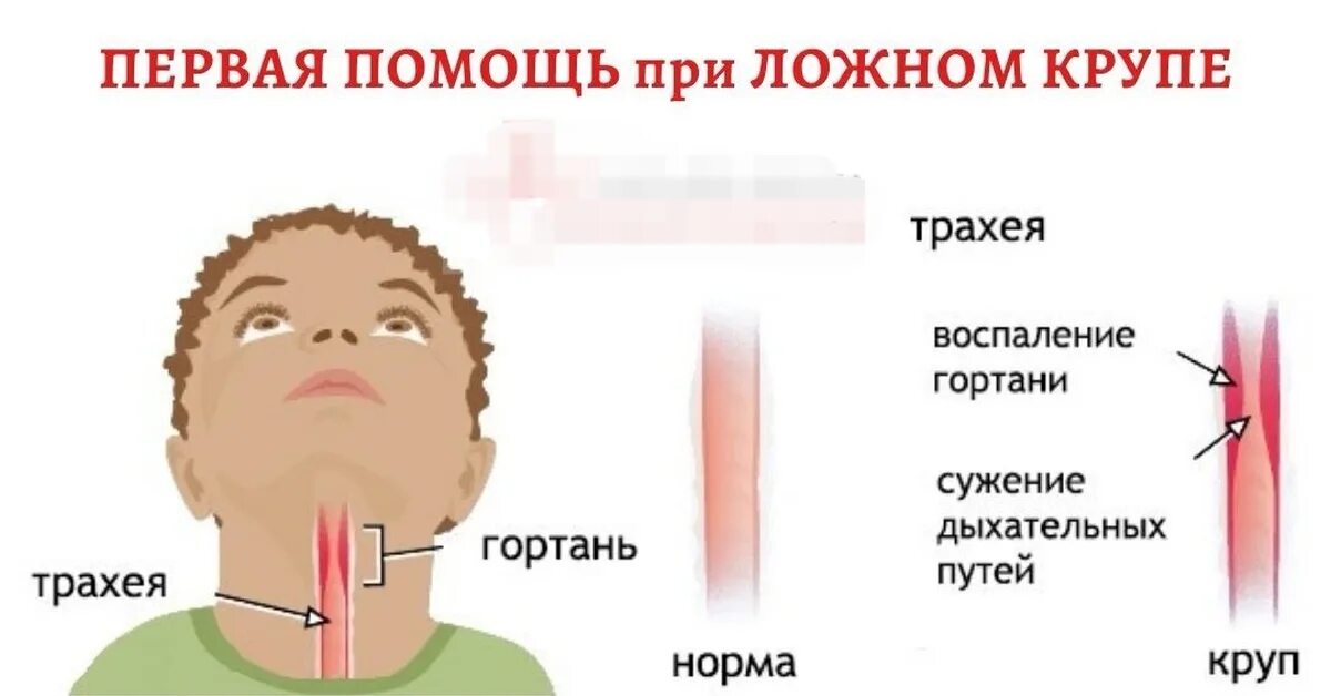 Ложный круп. Острый стенозирующий ларинготрахеит.. Причины острого стеноза гортани. Острый ларингит и стеноз гортани. Почему исчезает голос у человека