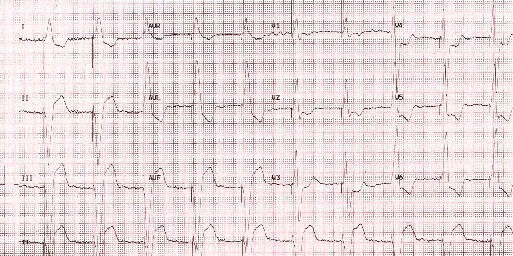 Qrs m 30. Расширение qrs на экг. qrs вниз. qrs перевернутый. парные нормальные qrs.