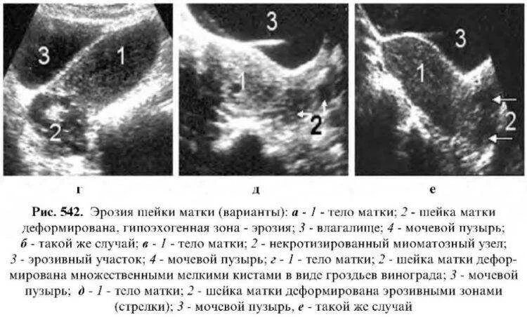 Эрозия на УЗИ малого таза. Ультразвуковое исследование шейки матки. Образования в полости матки на УЗИ. Образование шейки матки по УЗИ. Матка увеличена причины при осмотре у гинеколога