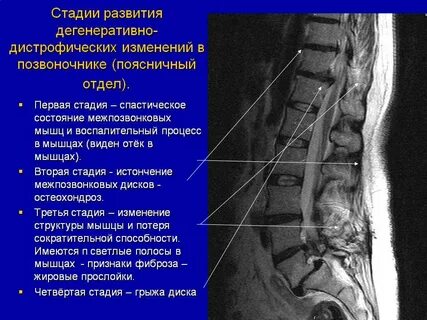 Дегенеративные изменения пояснично крестцового отдела что это