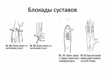 Коленная блокада