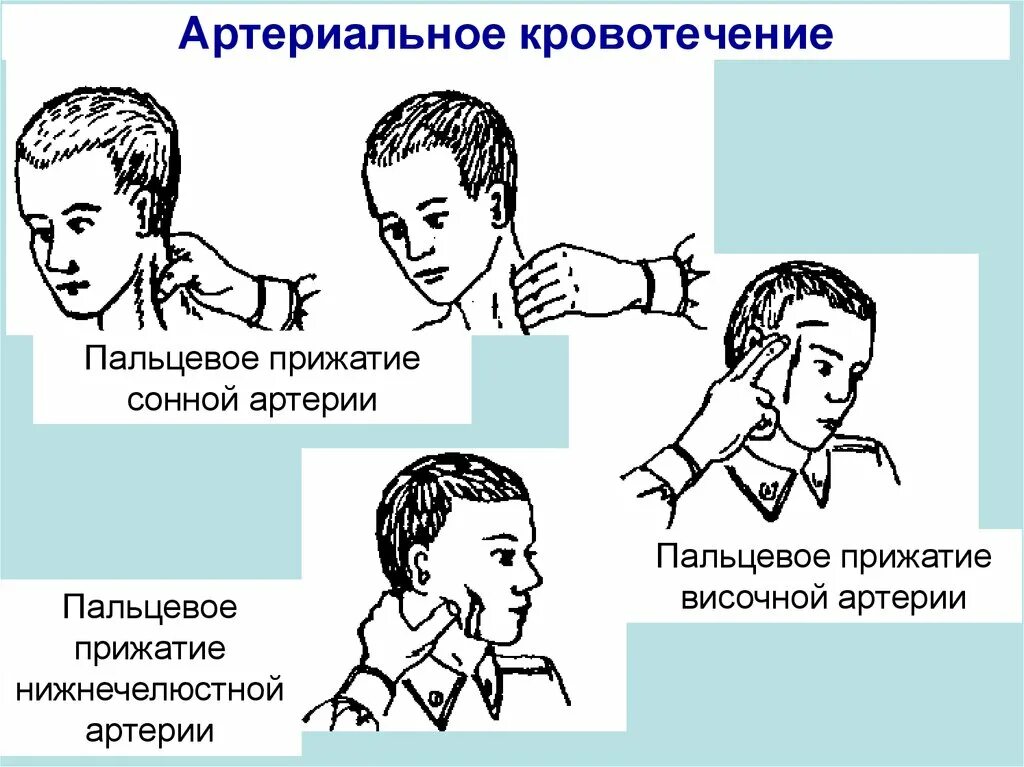 Остановить кровотечение на сонной артерии ответ тест. Остановка кровотечения из сонной артерии (пальцевое прижатие).. Пальцевое прижатие артерий сонной артерии. Пальцевое прижатие сонной арте. Пальцевое прижатие височной артерии.