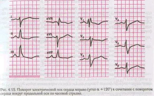 Поворот сердца по часовой стрелке. Поворот сердца вокруг поперечной оси верхушкой. Сердце против часовой стрелки. Поворот сердца по часовой стрелке. Поворот сердца по продольной оси против часовой стрелки.