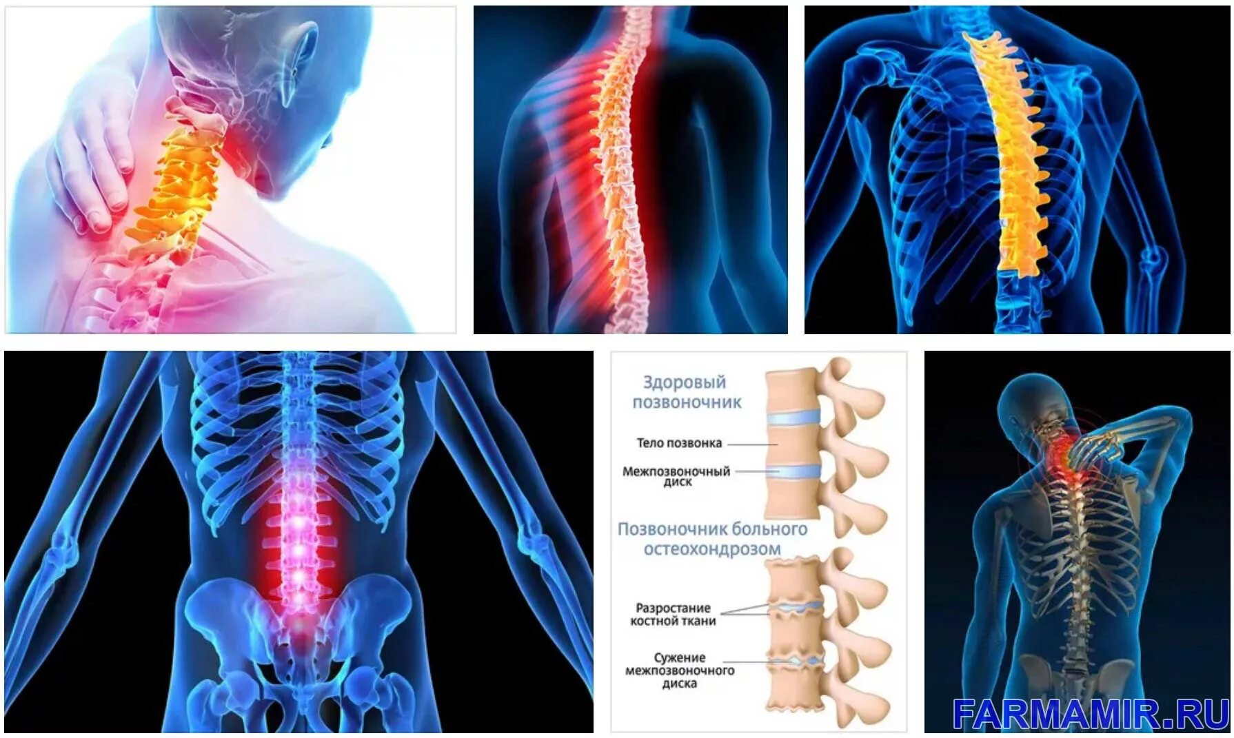 Остеохондроз шейного и грудного отдела позвоночника лечение. Остеохондроз позвоночника. Остеохондрома грудного отдела позвоночника. Остеохондроз спинного отдела. Остеохондроз рисунок.