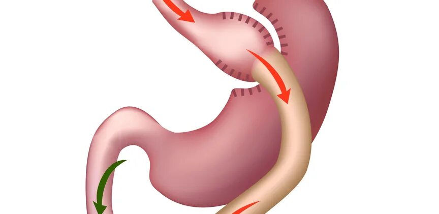 Резекция желудка анемия. Гастрошунтирование гастрошунтирование желудка. Мини гастрошунтирование желудка. Мини - гастрошунтирование (Mini- gastric Bypass). Резекция гастрошунтирование желудка.