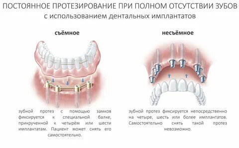 Через сколько после удаления зуба можно протезировать