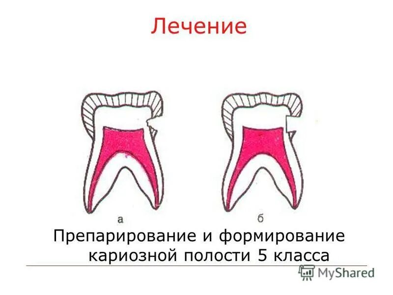 Раскрытие кариозной полости 1 класса. Финирование краев кариозной полости. Препарирование кариозной полости 1 класса. Препарирование по блэку 1 класс премоляр. Препарирование кариозной полости 1 класса.