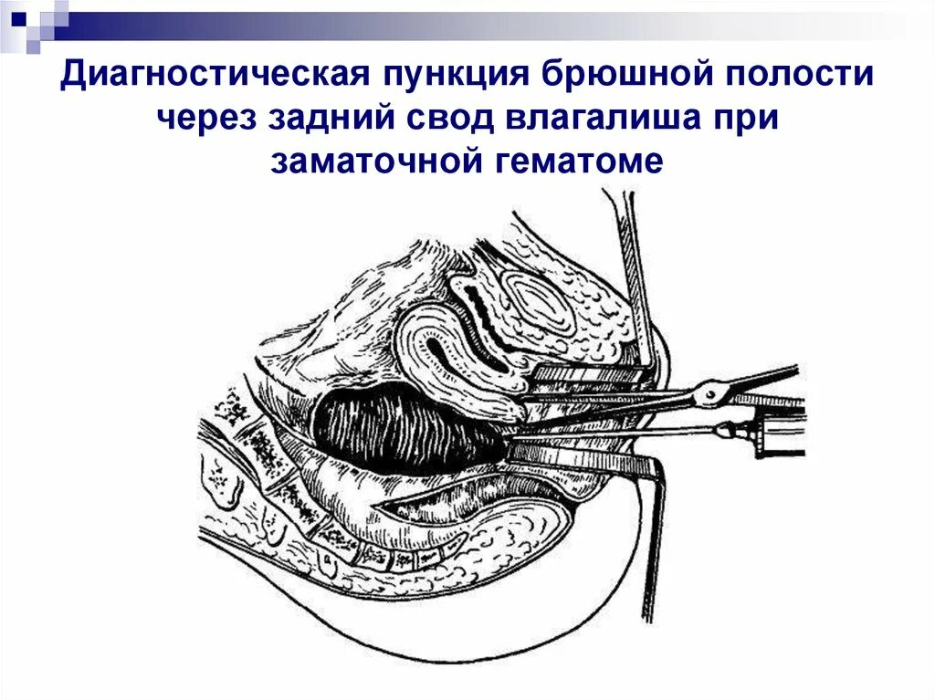 Пункция через задний свод. Пункция заднего свода брюшной полости. Набор инструментов для проведения пункции заднего свода. Пункция брюшной полости через задний свод. Пункция заднего свода в гинекологии алгоритм.