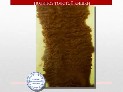 Полипоз толстой