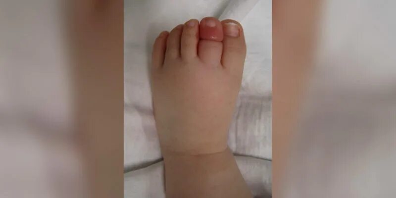 Волос на Пальчике у младенца. Синдром детского волосяного жгута. Синдром волосяного жгута мкб 10. Волос намотался на палец ребенку.