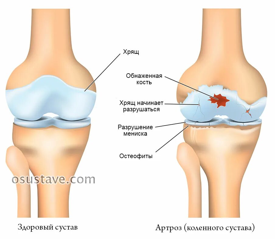 Лечение остеофитов сустав. Артроз коленного сустава остеофиты. остеоартроз рентген остеофиты. краевые остеофиты коленного сустава рентген.