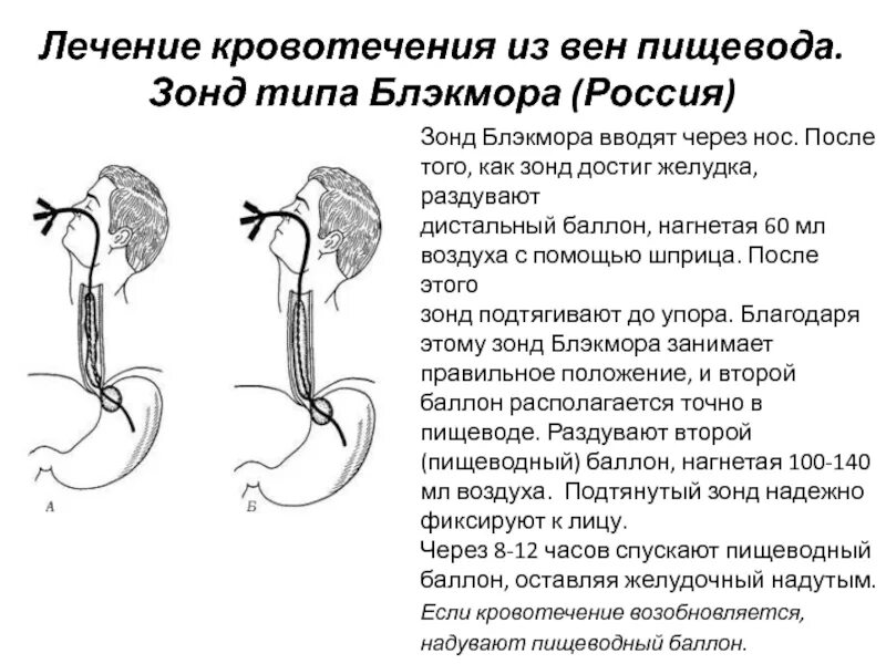 Лечение вен пищевода. Зонд Блэкмора для остановки кровотечения из вен пищевода. Зонд Блэкмора техника. Зонд Блэкмора при кровотечении. Постановка зонда Блэкмора.