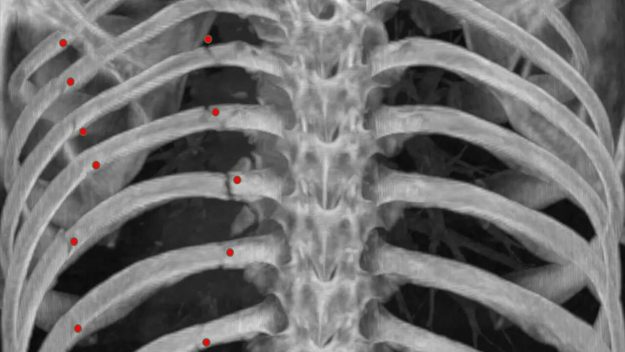 Перелом реберного хряща рентген. Перелом 1 ребра рентген. Поднадкостничный перелом ребра. Рентген грудной клетки перелом ребер.
