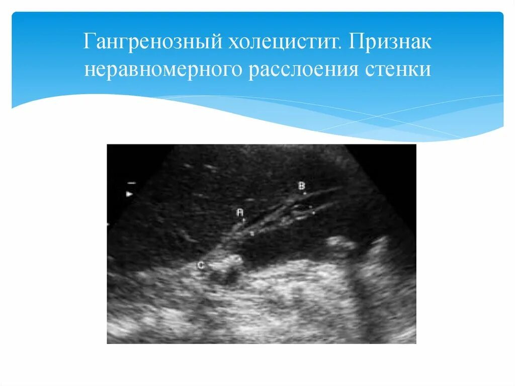 Морфологические формы острого холецистита. Острый гангренозный холецистит узи. Острый холецистит перфоративный. Острый флегмонозный холецистит. Клинические формы холецистита.