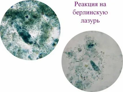 Кристаллы в мокроте