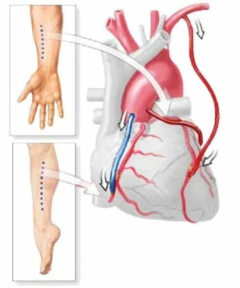 Шунтирование коронарных артерий. Аортокоронарное шунтирование (АКШ). Операция шунтирование сосудов сердца. Аорта коранарное шунтирование. Операция шунтирование ног