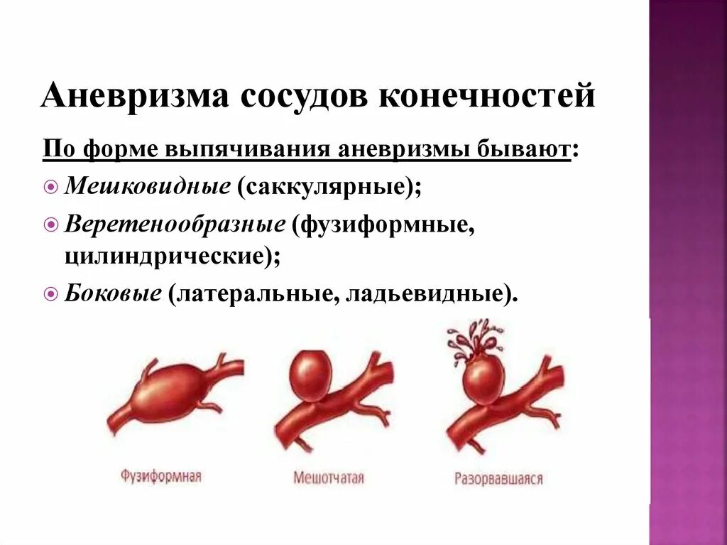 Классификация аневризм брюшной аорты. Мешотчатая аневризма сосудов. Аневризма классификация патанатомия. Аневризма классификация по форме. Аневризма мозга простыми словами