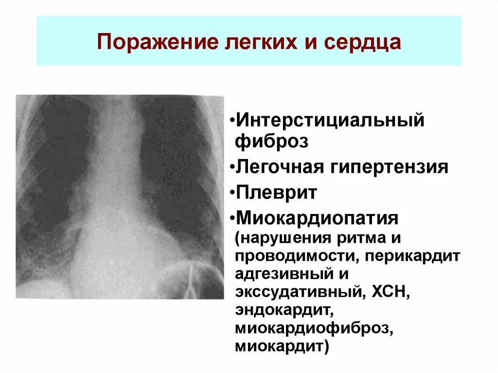 Легкие фиброзного характера. Пневмофиброз легочный фиброз. Интерстициальный легочный фиброз. Плевроперикардиальный фиброз что это такое. Диффузный легочный фиброз.