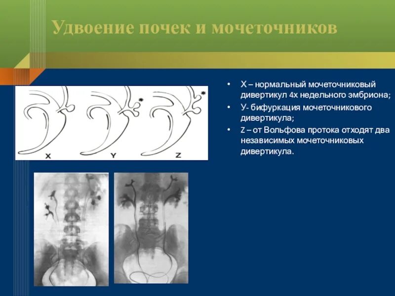 Удвоение мочеточника. Удвоение почек и мочеточников это. Неполное удвоение мочеточника. Виды удвоения мочеточника.