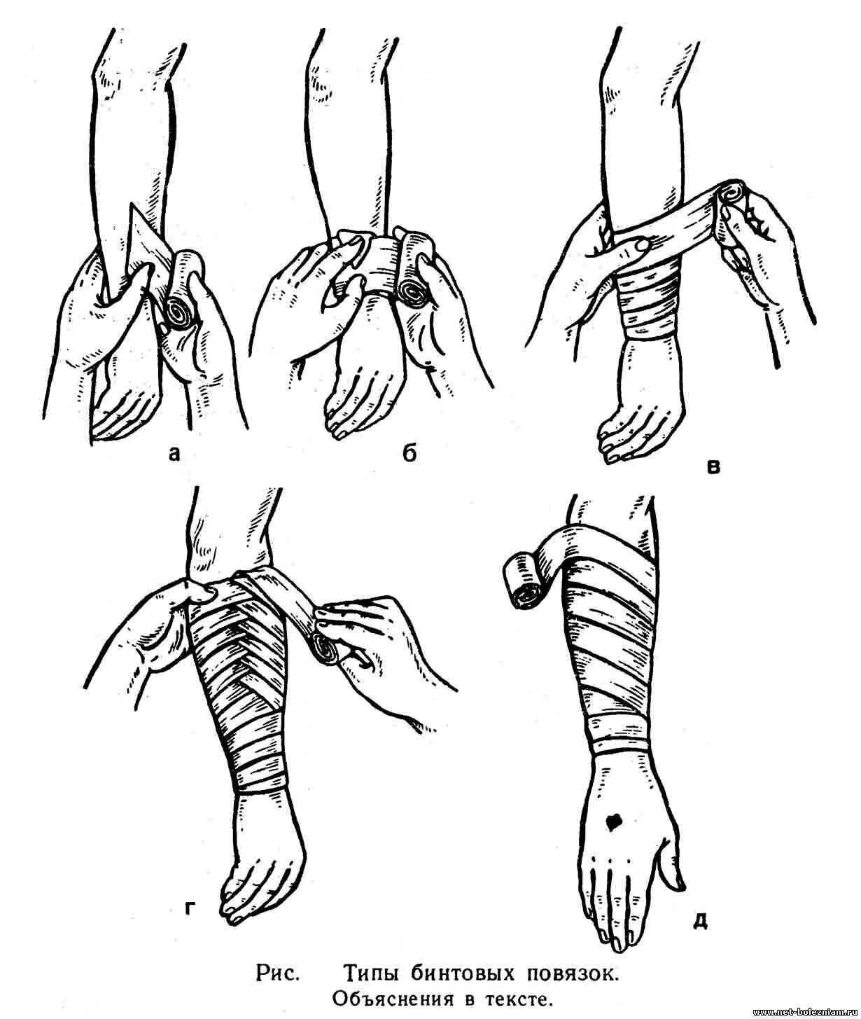Техника наложения эластичного. Колосовидная повязка на предплечье. Спиралевидная повязка на предплечье алгоритм. Перевязка колосовидная на предплечье. Колосовидная повязка на предплечье алгоритм.