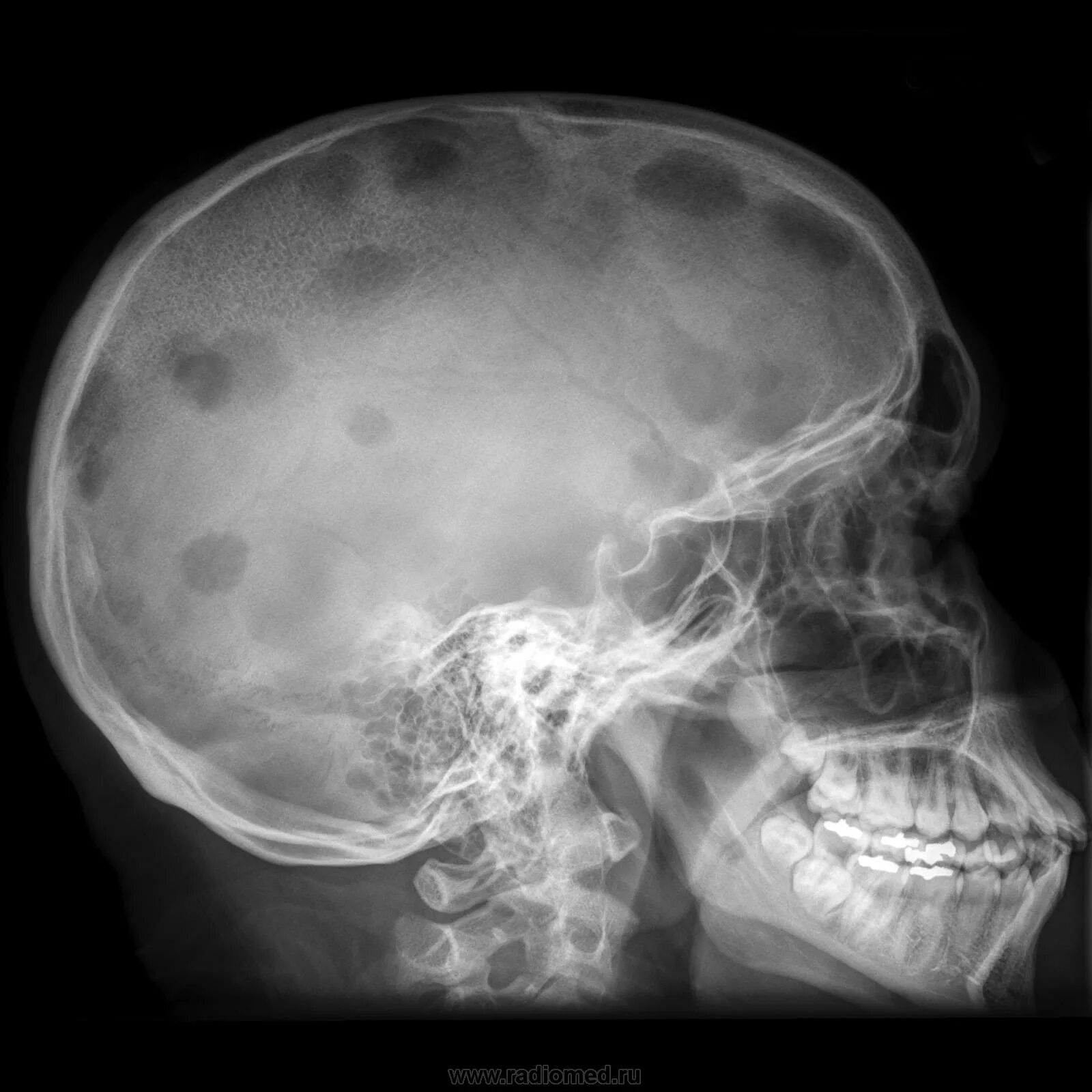 Кости черепа рентген. Остеома костей черепа кт. Миеломная болезнь рентген черепа. Эозинофильная гранулема костей черепа. Фиброзная дисплазия черепа рентген.
