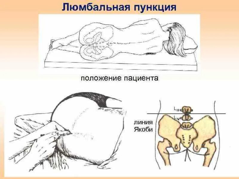 Спинномозговая пункция алгоритм. Положение пациента при люмбальной пункции. спинномозговая люмбальная пункция показания техника. положение больного при проведении люмбальной пункции. положение пациента при проведении спинномозговой пункции.