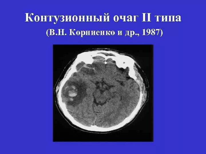 Что значит очаг в головном мозге. Контузионный очаг в головном мозге. Контузионные очаги головного мозга на кт. Контузионный очаг 2 типа кт. Очаги ушиба головного мозга на кт.