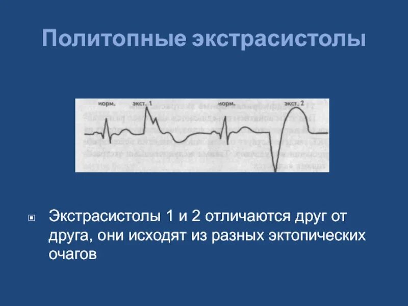 Политопная экстрасистолия на ЭКГ. Политопная желудочковая экстрасистолия. Желудочковая экстрасистолия, ЖЭС. Парные мономорфные экстрасистолы. Политопные экстрасистолы