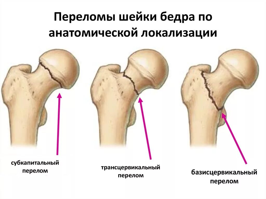 Трещина шейки