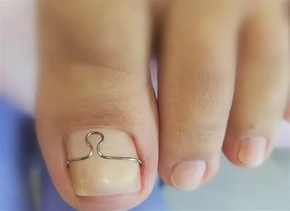 аппаратный педикюр в салоне. подологический педикюр. специалист по вросшим ногтям. медицинский аппаратный педикюр. титановая нить пододоги.